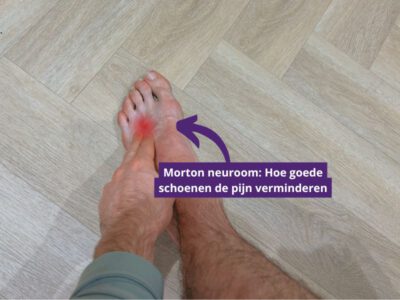 Goede schoenen voor morton neuroom (die de pijn verminderen)