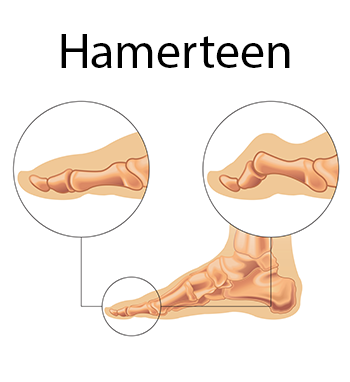 Hamertenen voorbeeld Penninx Schoenen Gemert