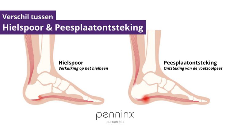 Peesplaatontsteking schoenen deals