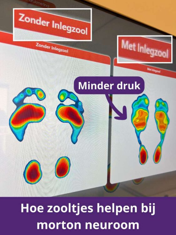 Inlegzooltjes bij morton neuroom