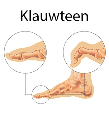 Klauwtenen voorbeeld Penninx Schoenen Gemert