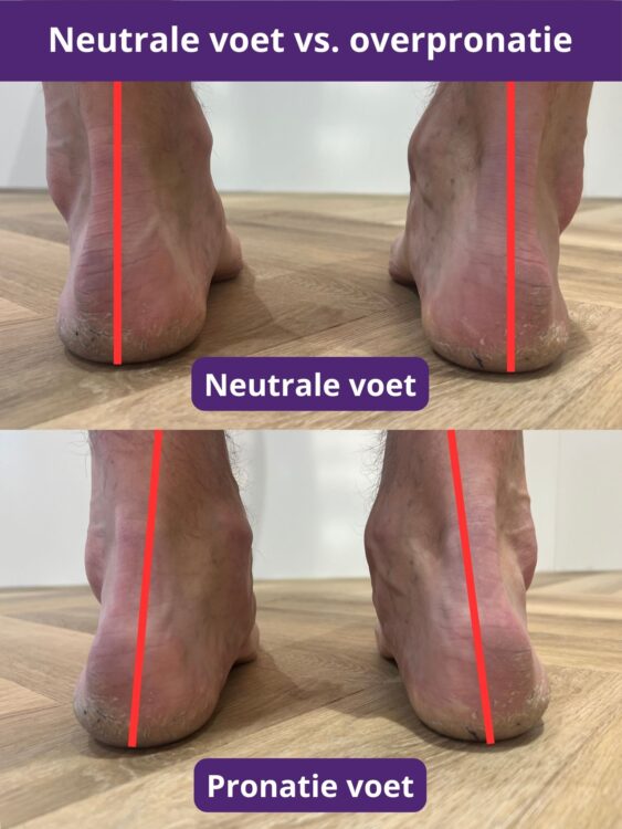Vergelijking van een neutrale voetstand vs. overpronatie
