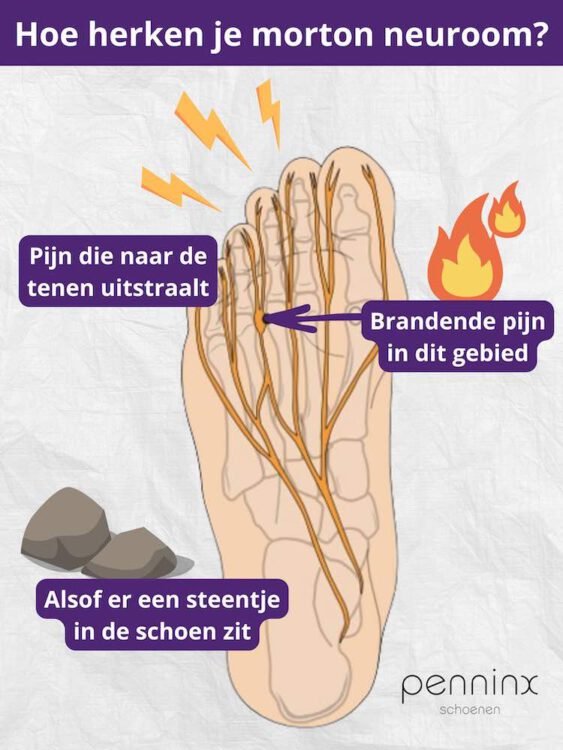 Symptomen van morton neuroom