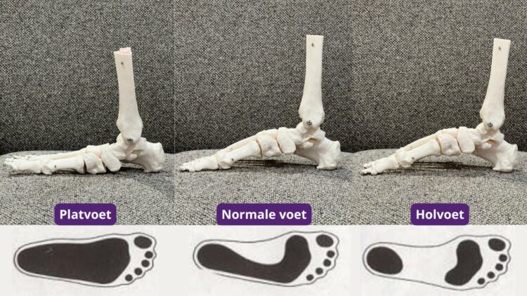 Verschil platvoet, holvoet en normale voet