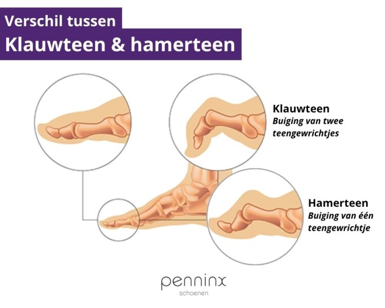 Verschil tussen Klauwteen & hamerteen