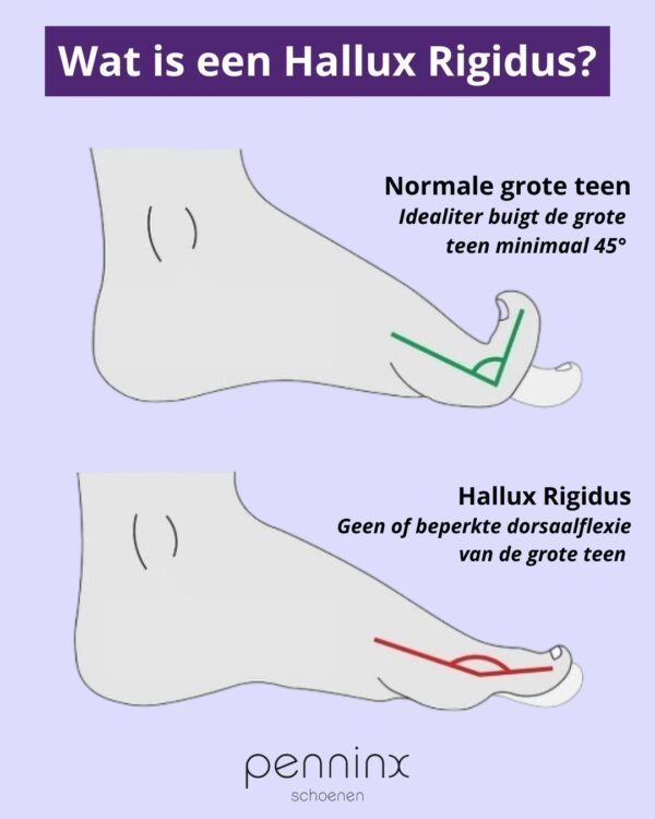 Wat is een Hallux Rigidus