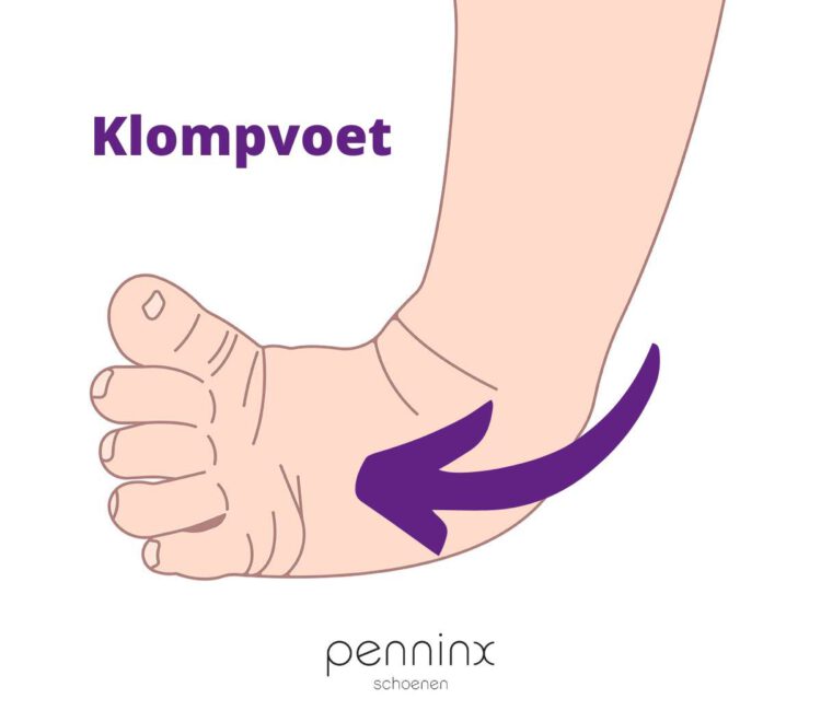 Wat is een klompvoet?