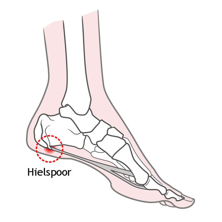 Wat is hielspoor - Penninx Schoenen