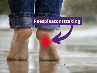 Welke schoenen bij peesplaatontsteking? Onze top 3 en kooptips