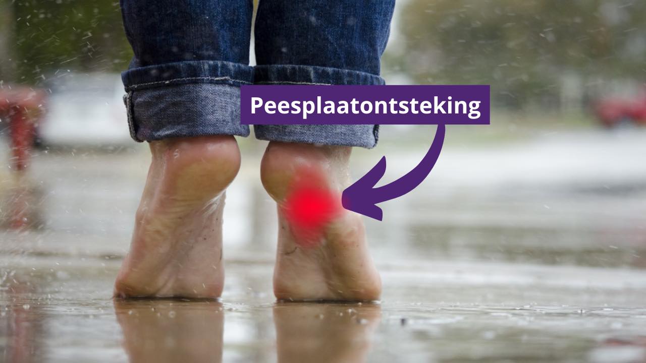 Schoenen bij peesplaatontsteking Onze top 3 en kooptips
