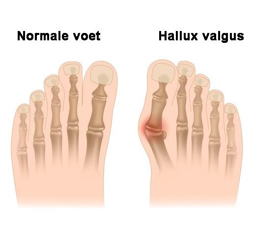 wat-is-hallux-valgus_penninx